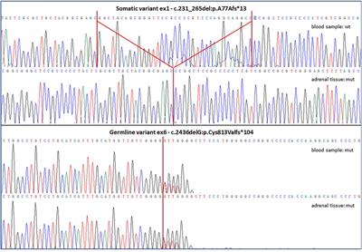 Case Report: A Novel ARMC5 Germline Mutation in a Patient with Primary Bilateral Macronodular Adrenal Hyperplasia and Hypogammaglobulinemia